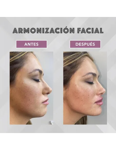 Armonización facial