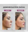 Armonización facial