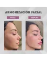 Armonización facial